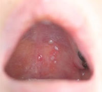 口腔内に発症した帯状疱疹