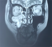 術後性上顎嚢胞画像