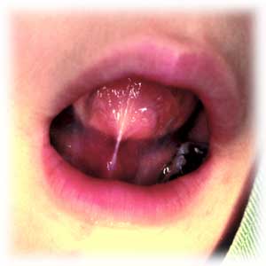舌小帯の付着異常（舌小帯強直症）