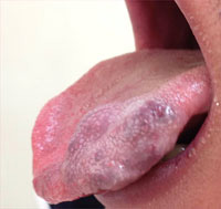 舌リンパ管腫
