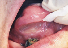 舌の褥瘡性潰瘍