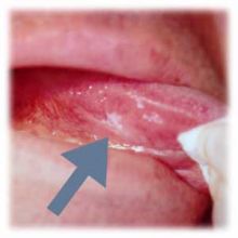 舌に生じた白板状病変（舌白板症）