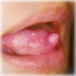舌のできもの（舌良性腫瘍）